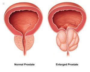 enlarge prostate