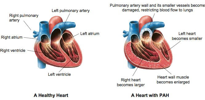 Changes observed in heart with PAH