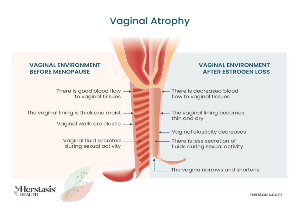 Vaginal Atrophy for menopause