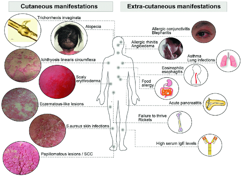 Various manifestations of Netherton Syndrome 