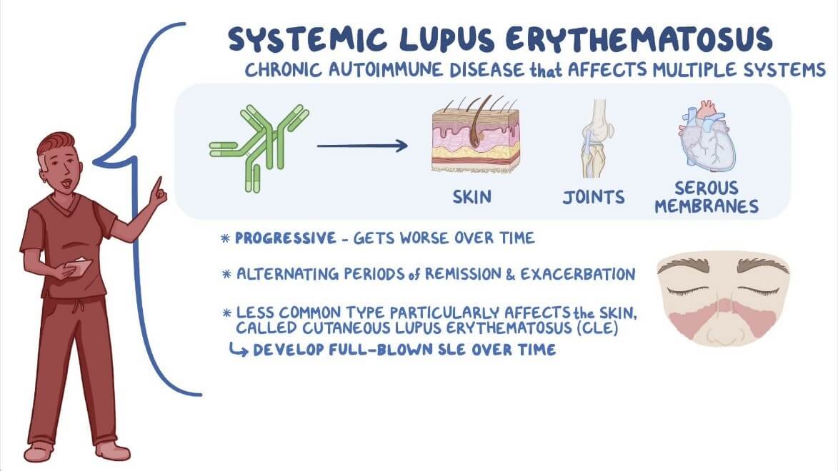 Systemic Lupus 