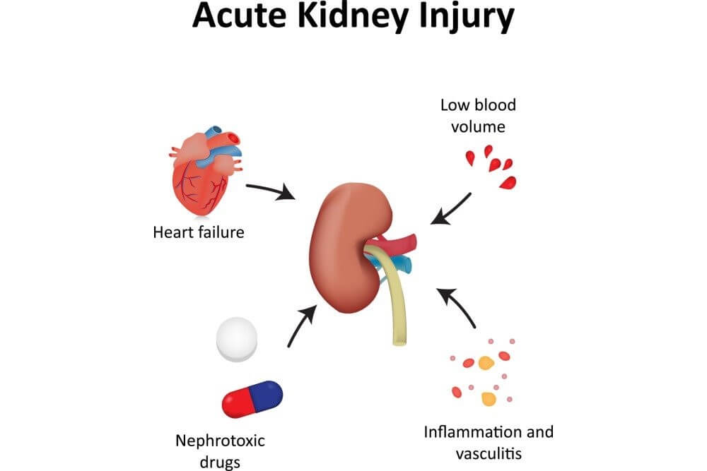 Acute Kidney injury Report 2024-2034