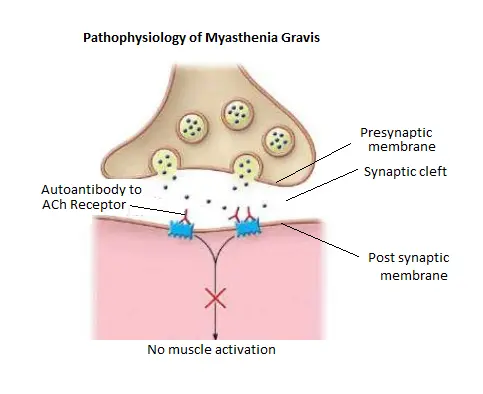 Pathophysiology of Myasthenia Gravis