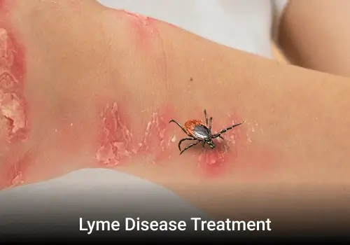 Commercialization and Pricing Analysis for Therapeutics for Lyme Disease Treatment