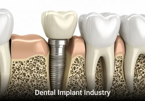 Voice-of-Customer Analysis for Dental Implant Industry
